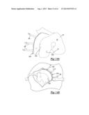 Patient-Specific Knee Alignment Guide And Associated Method diagram and image