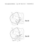 Patient-Specific Knee Alignment Guide And Associated Method diagram and image