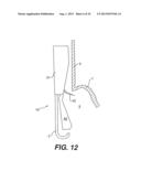 FLEXIBLE ENDOSCOPIC SURGICAL INSTRUMENT FOR INVAGINATION AND     FUNDOPLICATION diagram and image