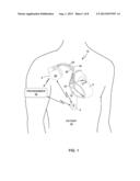 TECHNIQUES FOR MITIGATING MOTION ARTIFACTS FROM IMPLANTABLE PHYSIOLOGICAL     SENSORS diagram and image