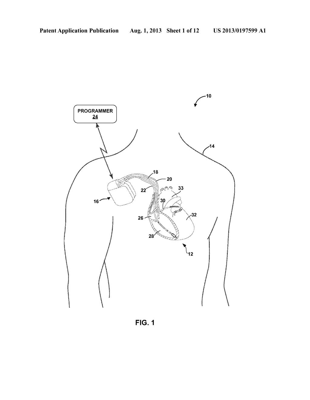 ADAPTIVE CARDIAC RESYNCHRONIZATION THERAPY - diagram, schematic, and image 02