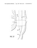 Inversion Delivery Device And Method For A Prosthesis diagram and image