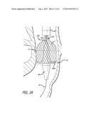 Inversion Delivery Device And Method For A Prosthesis diagram and image