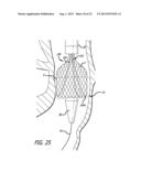 Inversion Delivery Device And Method For A Prosthesis diagram and image