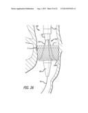 Inversion Delivery Device And Method For A Prosthesis diagram and image