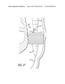 Inversion Delivery Device And Method For A Prosthesis diagram and image