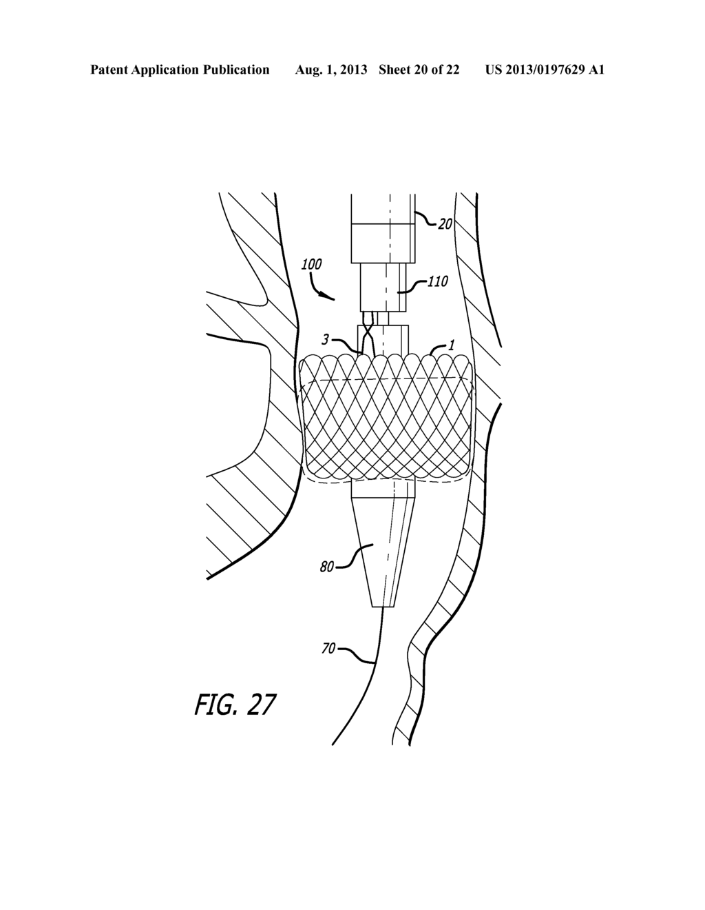 Inversion Delivery Device And Method For A Prosthesis - diagram, schematic, and image 21