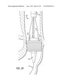 Inversion Delivery Device And Method For A Prosthesis diagram and image