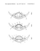 INTRAOCULAR LENS IMPLANT diagram and image