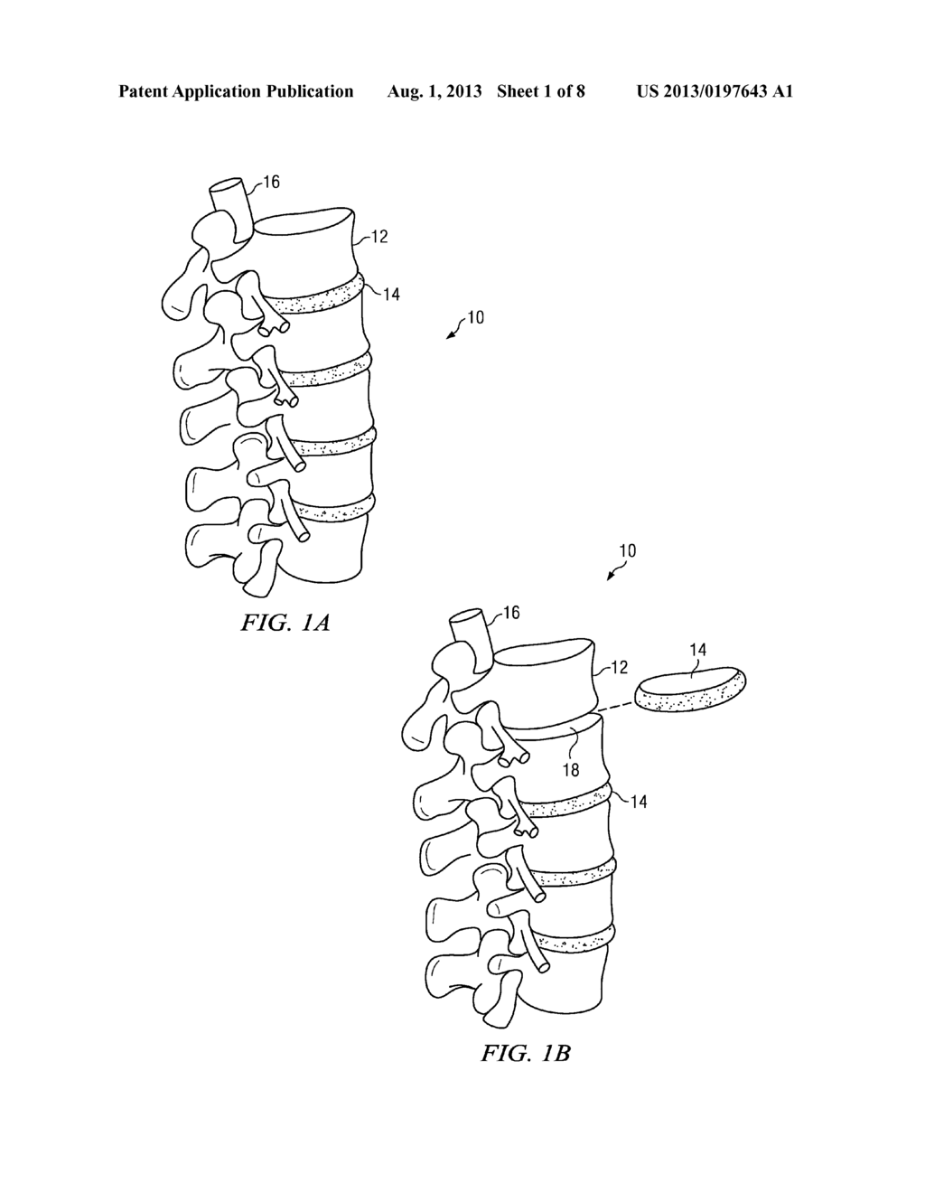 INTERVERTEBRAL DISC PROSTHESIS AND METHOD - diagram, schematic, and image 02