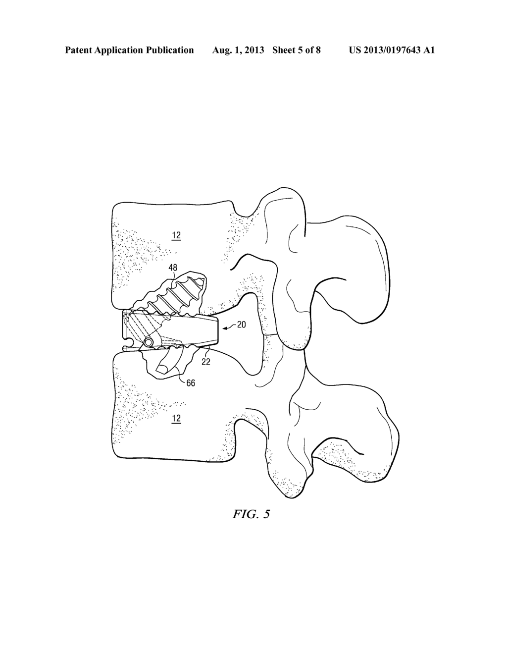 INTERVERTEBRAL DISC PROSTHESIS AND METHOD - diagram, schematic, and image 06