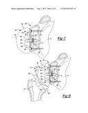 CONVERTIBLE GLENOID IMPLANT diagram and image