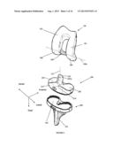 PROSTHETIC JOINT diagram and image