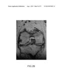 SYSTEM AND METHOD FOR IMAGE SEGMENTATION IN GENERATING COMPUTER MODELS OF     A JOINT TO UNDERGO ARTHROPLASTY diagram and image