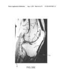 SYSTEM AND METHOD FOR IMAGE SEGMENTATION IN GENERATING COMPUTER MODELS OF     A JOINT TO UNDERGO ARTHROPLASTY diagram and image