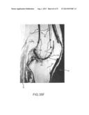 SYSTEM AND METHOD FOR IMAGE SEGMENTATION IN GENERATING COMPUTER MODELS OF     A JOINT TO UNDERGO ARTHROPLASTY diagram and image