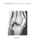 SYSTEM AND METHOD FOR IMAGE SEGMENTATION IN GENERATING COMPUTER MODELS OF     A JOINT TO UNDERGO ARTHROPLASTY diagram and image