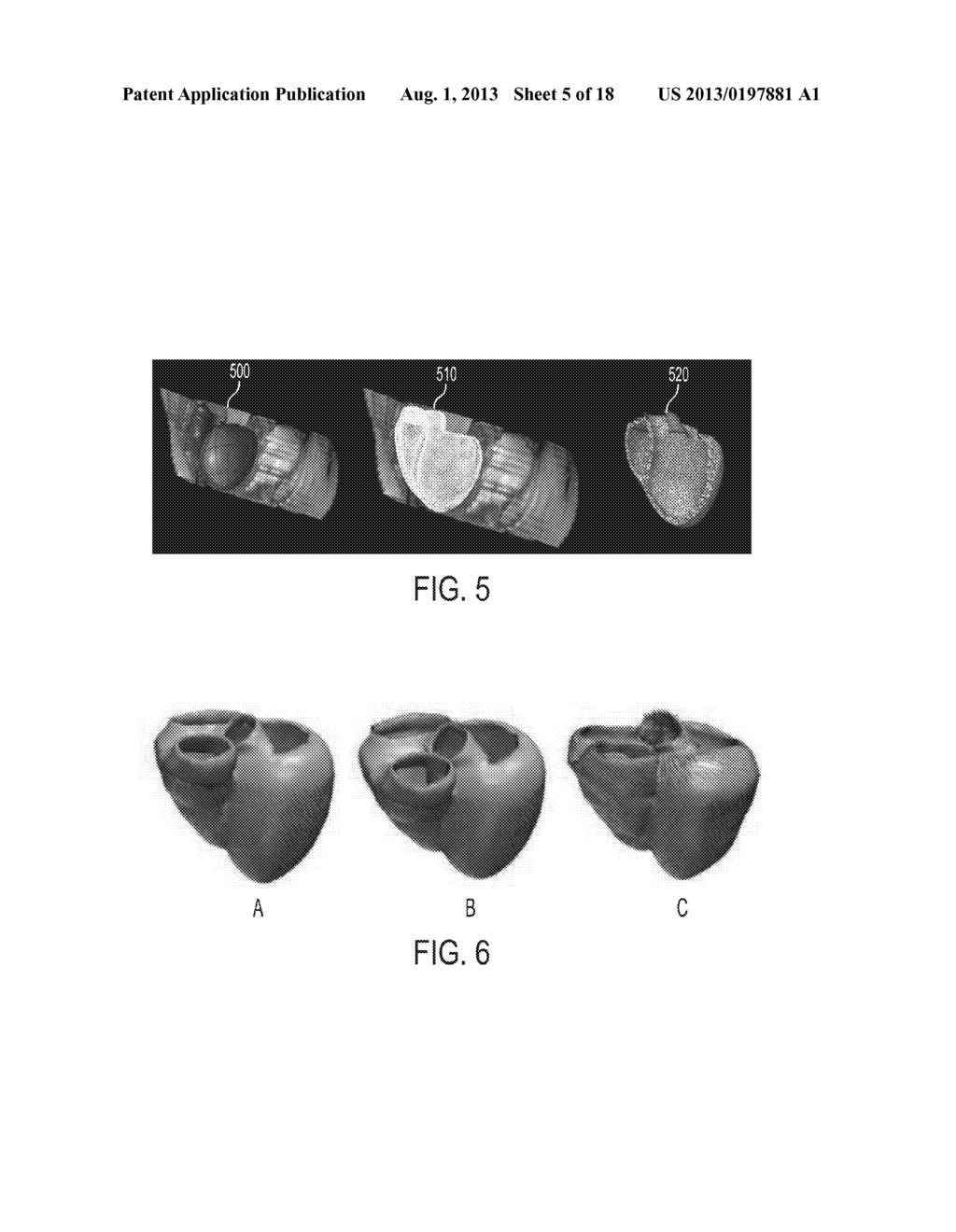 Method and System for Patient Specific Planning of Cardiac Therapies on     Preoperative Clinical Data and Medical Images - diagram, schematic, and image 06