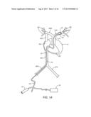 Apparatus and Methods For Treating Pulmonary Hypertension diagram and image