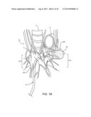 Apparatus and Methods For Treating Pulmonary Hypertension diagram and image