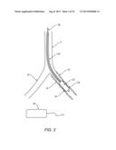 Apparatus and Methods For Treating Pulmonary Hypertension diagram and image