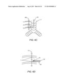 Apparatus and Methods For Treating Pulmonary Hypertension diagram and image