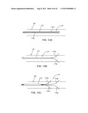 Apparatus and Methods For Treating Pulmonary Hypertension diagram and image