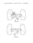 Apparatus and Methods For Treating Pulmonary Hypertension diagram and image