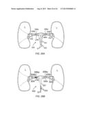 Apparatus and Methods For Treating Pulmonary Hypertension diagram and image