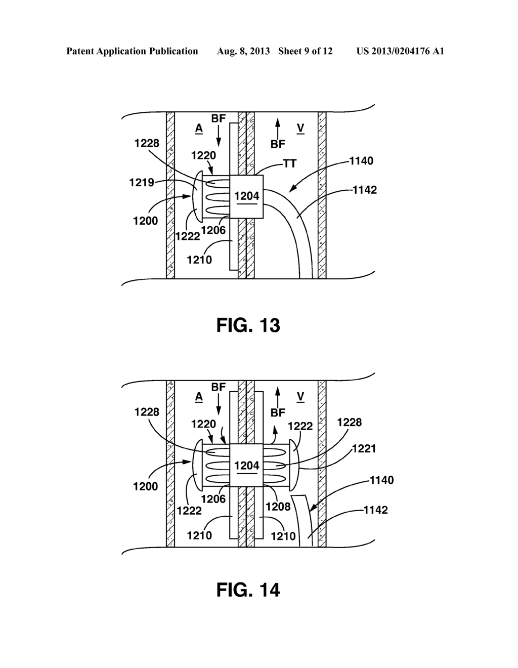 Arteriovenous Shunt Having a Moveable Valve - diagram, schematic, and image 10