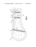 Method And Apparatus For Aligning Bone Screw Holes diagram and image