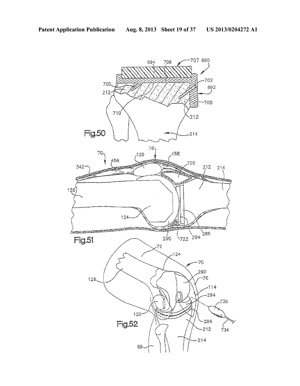 METHOD FOR ROBOTIC ARTHROPLASTY USING NAVIGATION - diagram, schematic, and image 20