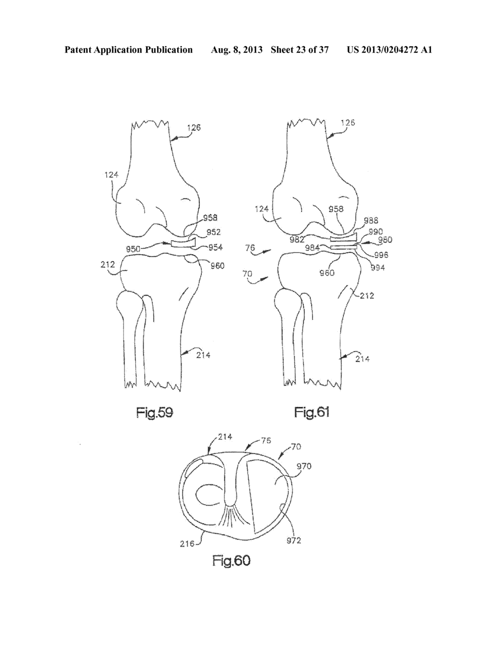 METHOD FOR ROBOTIC ARTHROPLASTY USING NAVIGATION - diagram, schematic, and image 24