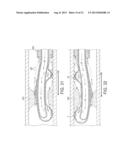 Rotational Atherectomy Device with Fluid Inflatable Support Elements and     Distal Protection Capability diagram and image