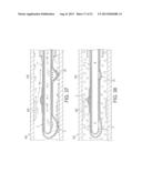 Rotational Atherectomy Device with Fluid Inflatable Support Elements and     Distal Protection Capability diagram and image