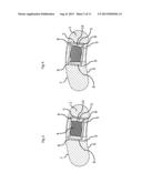 BONE PLATE FOR ELASTIC OSTEOSYNTHESIS diagram and image