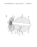 BONE PLATE FOR ELASTIC OSTEOSYNTHESIS diagram and image