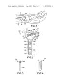 Volar Fixation System diagram and image