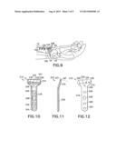 Volar Fixation System diagram and image