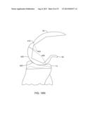 SYSTEMS AND METHODS FOR PROVIDING A MODULAR FEMORAL COMPONENT diagram and image