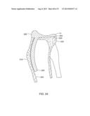 SYSTEMS AND METHODS FOR PROVIDING A MODULAR FEMORAL COMPONENT diagram and image