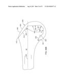 SYSTEMS AND METHODS FOR PROVIDING A MODULAR FEMORAL COMPONENT diagram and image