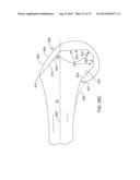 SYSTEMS AND METHODS FOR PROVIDING A MODULAR FEMORAL COMPONENT diagram and image