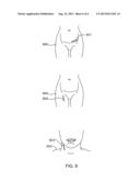 Surgical Retractor diagram and image