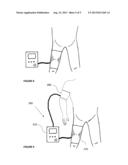 MULTI-MODE INFLATABLE LIMB OCCLUSION DEVICE diagram and image