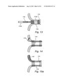 Device, A Kit And A Method For Treatment Of Disorders In The Heart Rhythm     Regulation System diagram and image