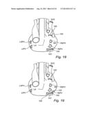 Device, A Kit And A Method For Treatment Of Disorders In The Heart Rhythm     Regulation System diagram and image