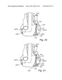 Device, A Kit And A Method For Treatment Of Disorders In The Heart Rhythm     Regulation System diagram and image