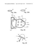 Device, A Kit And A Method For Treatment Of Disorders In The Heart Rhythm     Regulation System diagram and image