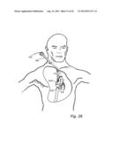 Device, A Kit And A Method For Treatment Of Disorders In The Heart Rhythm     Regulation System diagram and image